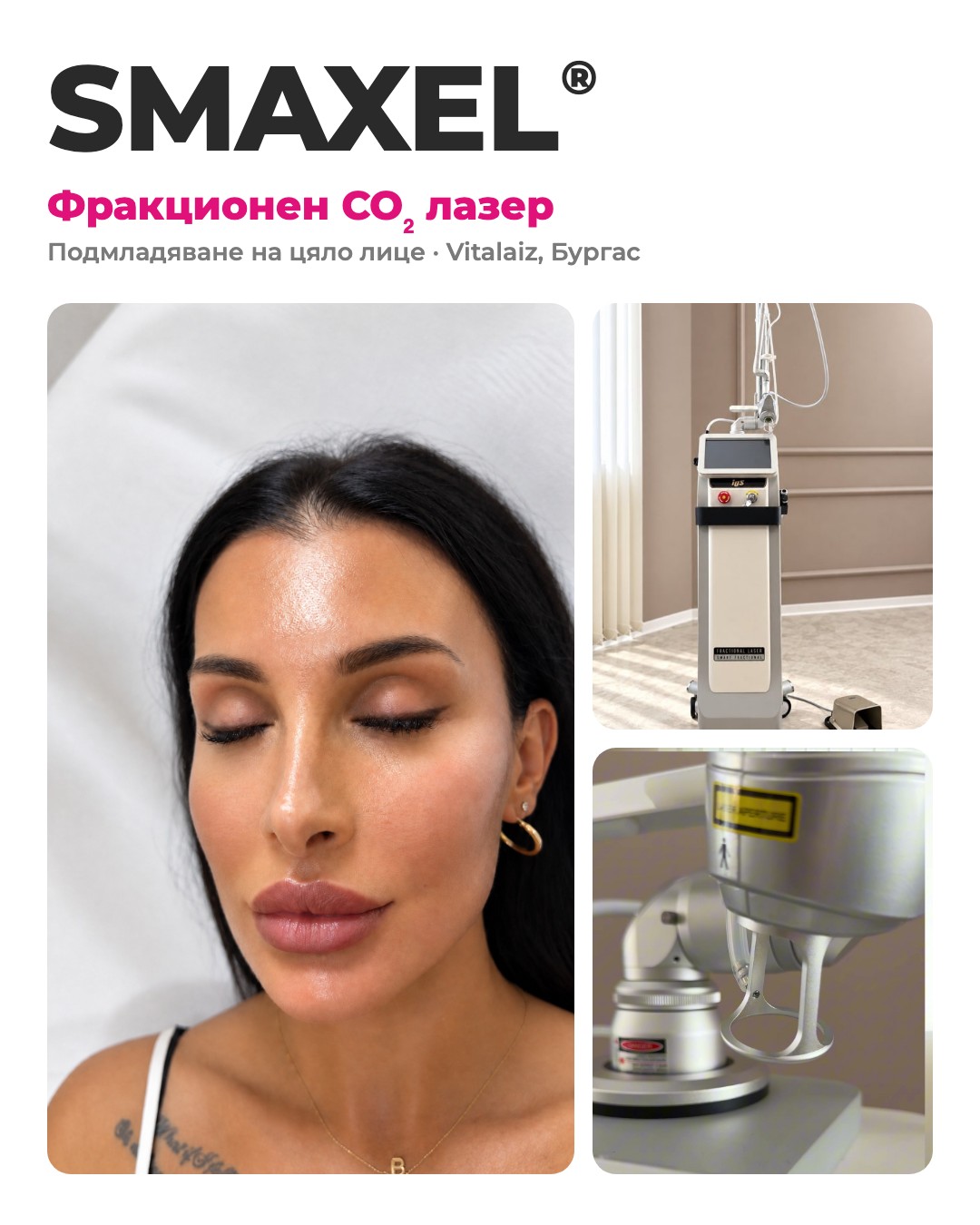 Фракционен CO2 лазер SMAXEL във Vitalaiz, Бургас