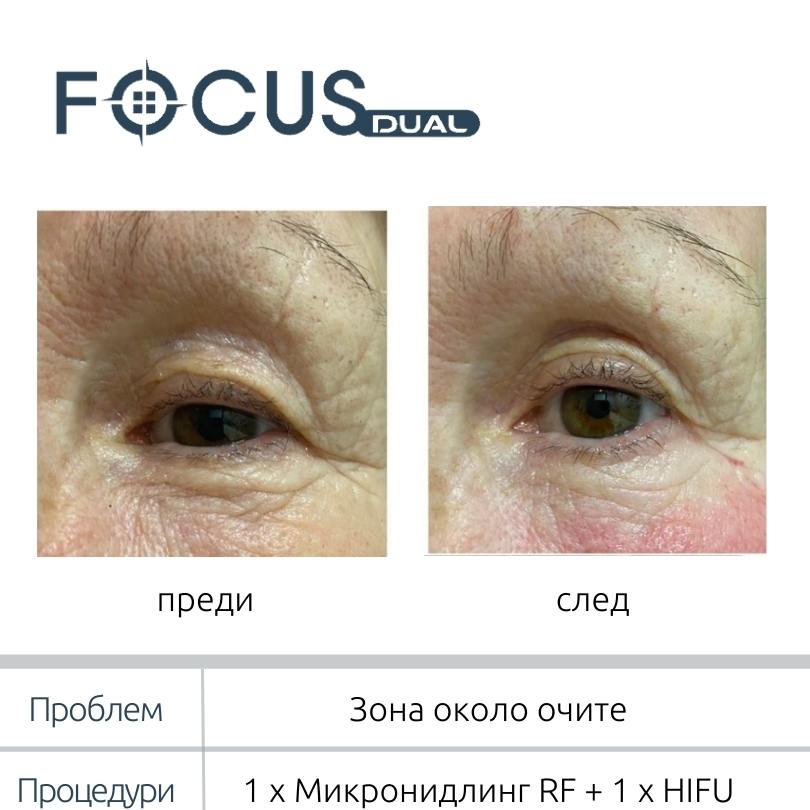 Клиентка на Vitalaiz: 1 × RF микронийдлинг + 1 × HIFU на зоната около очите.